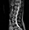 МРТ позвоночника